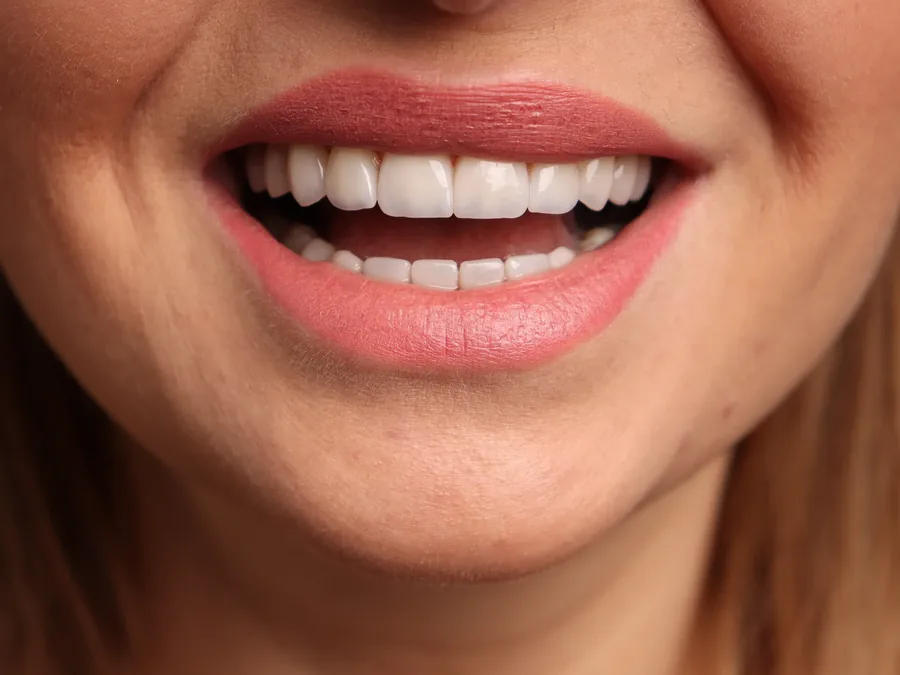 Close up of a patient’s smile after treatment