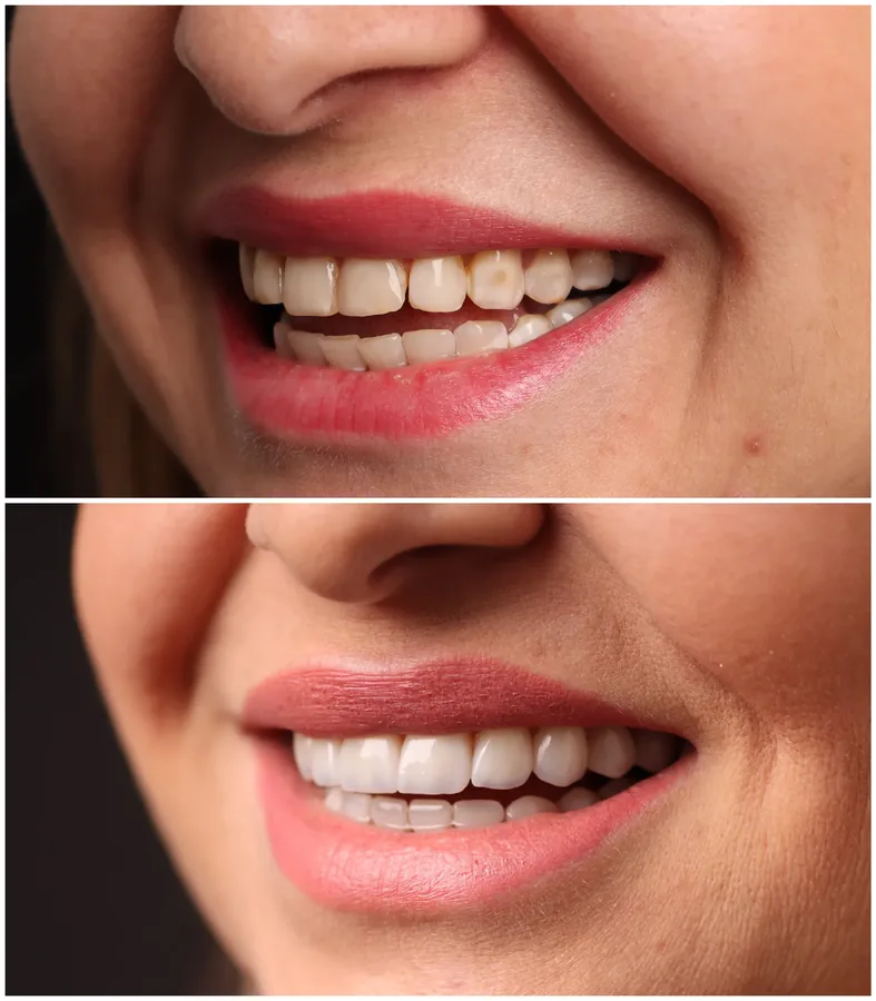 Before and after of a smile transformation, three quarter view